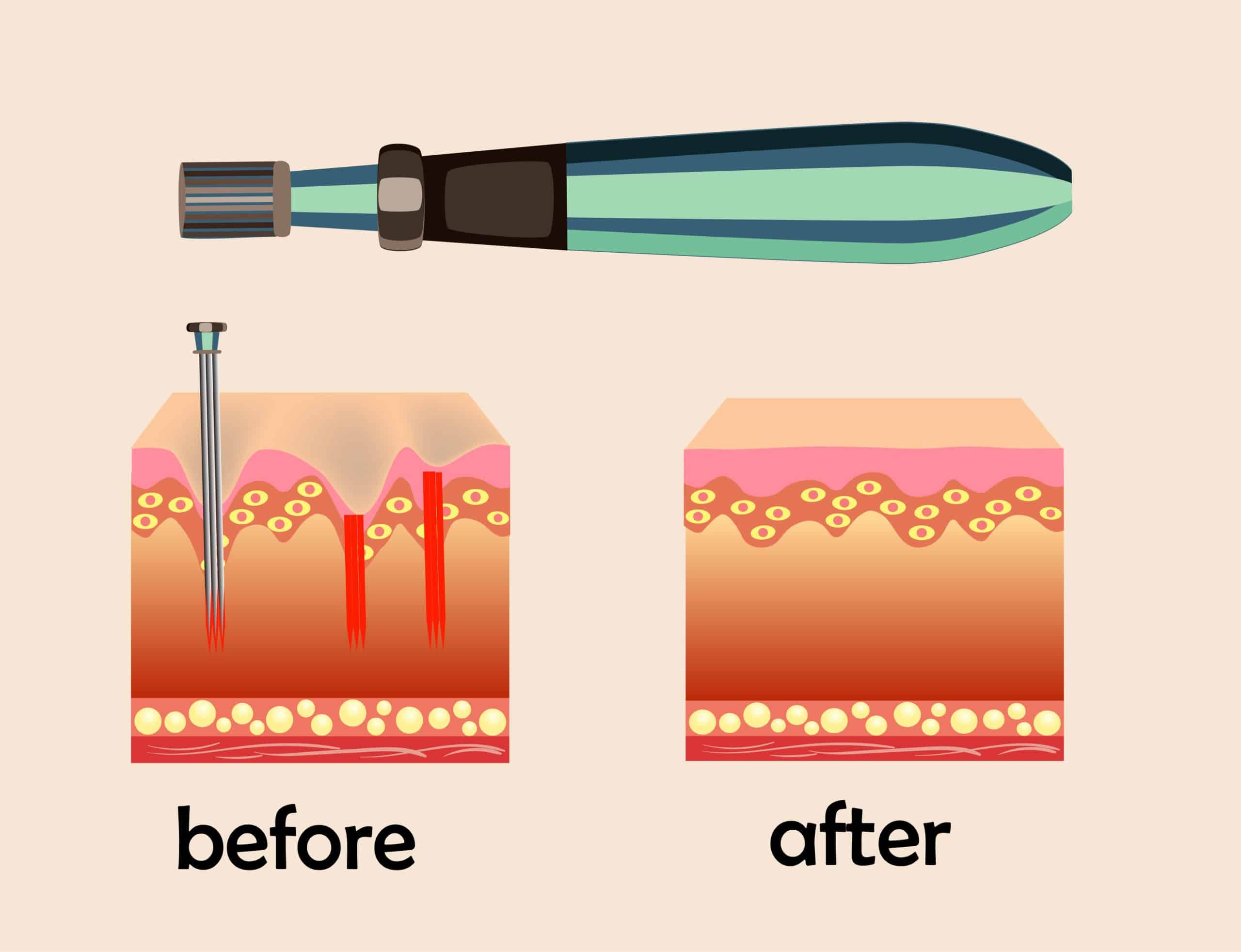 Before after effect, Microneedle stamping device, Collagen induction therapy | Cloud 9 MedSpa in Casa Grande, AZ