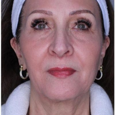Photo After Beauty Treatment | Cloud 9 MedSpa in Casa Grande, AZ