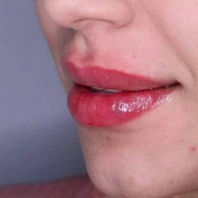 Woman Photo After Lips Treatment | Cloud 9 MedSpa in Casa Grande, AZ