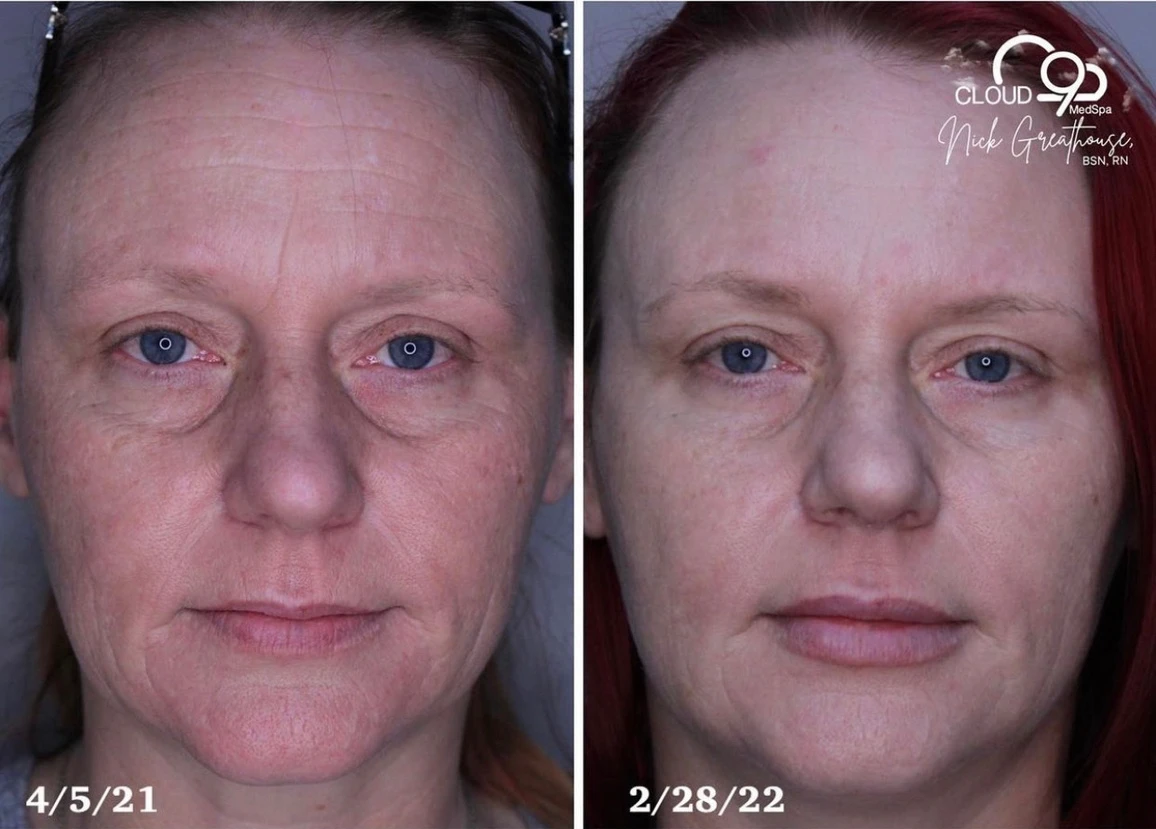 Biostimulation and collagen