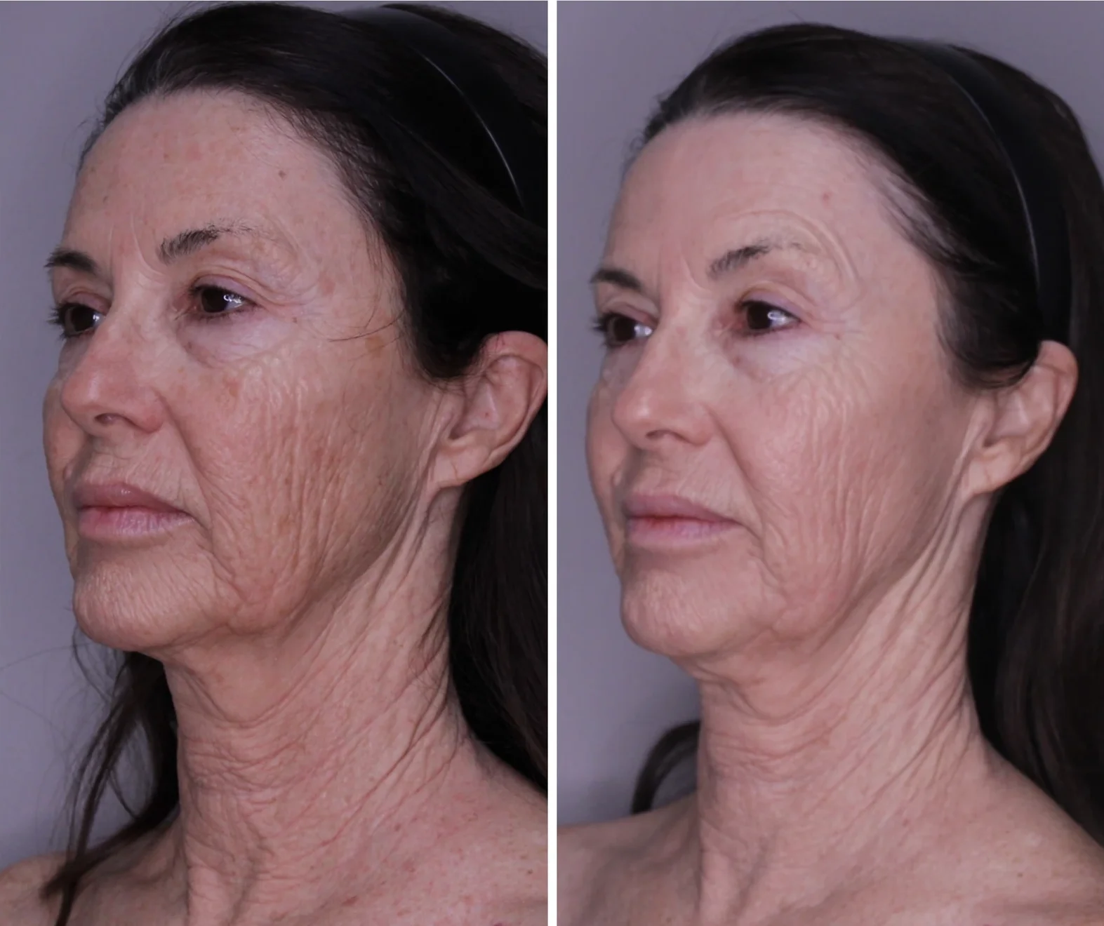 woman with BIOSTIMULATION + COLLAGEN INDUCTION treatment on her face
