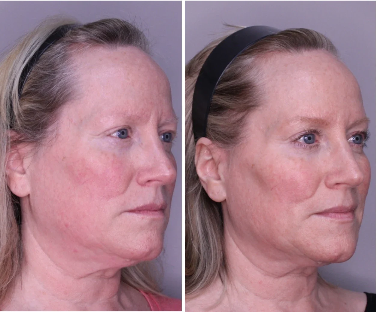 Neurotoxins Dermal Filler before and after
