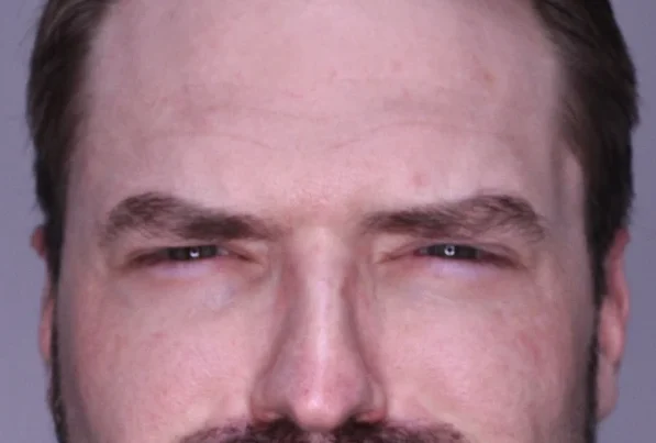 Neurotoxins Dermal Filler before and after