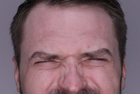 Neurotoxins Dermal Filler before and after