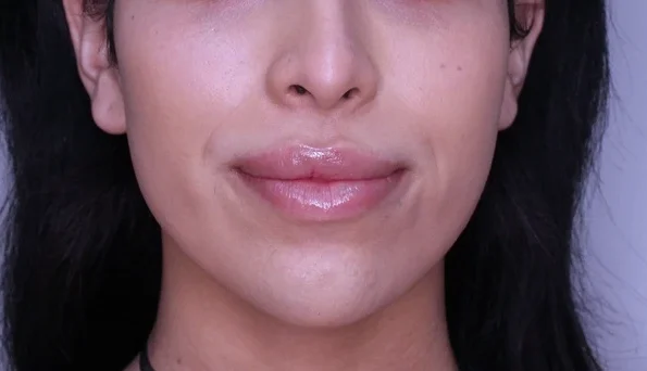 Neurotoxins Dermal Filler before and after