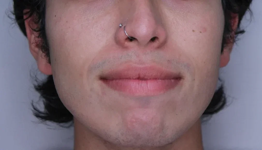 NEUROTOXINS AND DERMAL FILLER