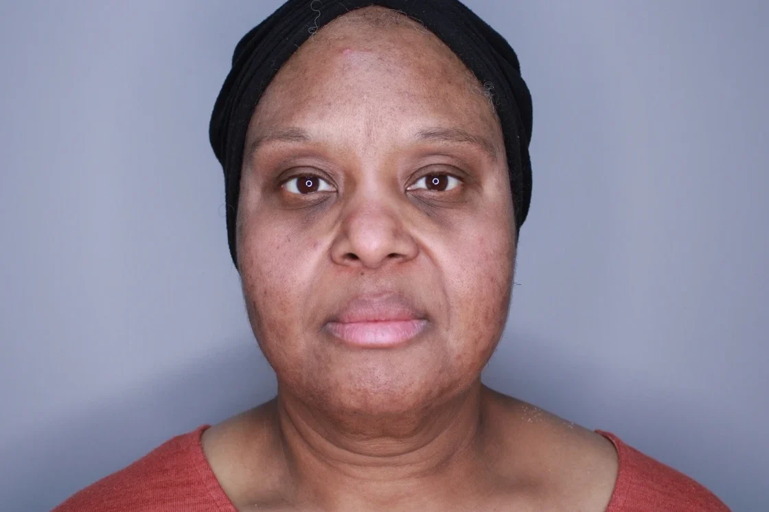 Skin Rejuvenation Cloud 9 medspa