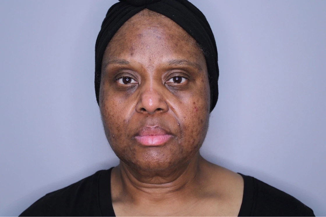 Skin Rejuvenation Cloud9 medspa