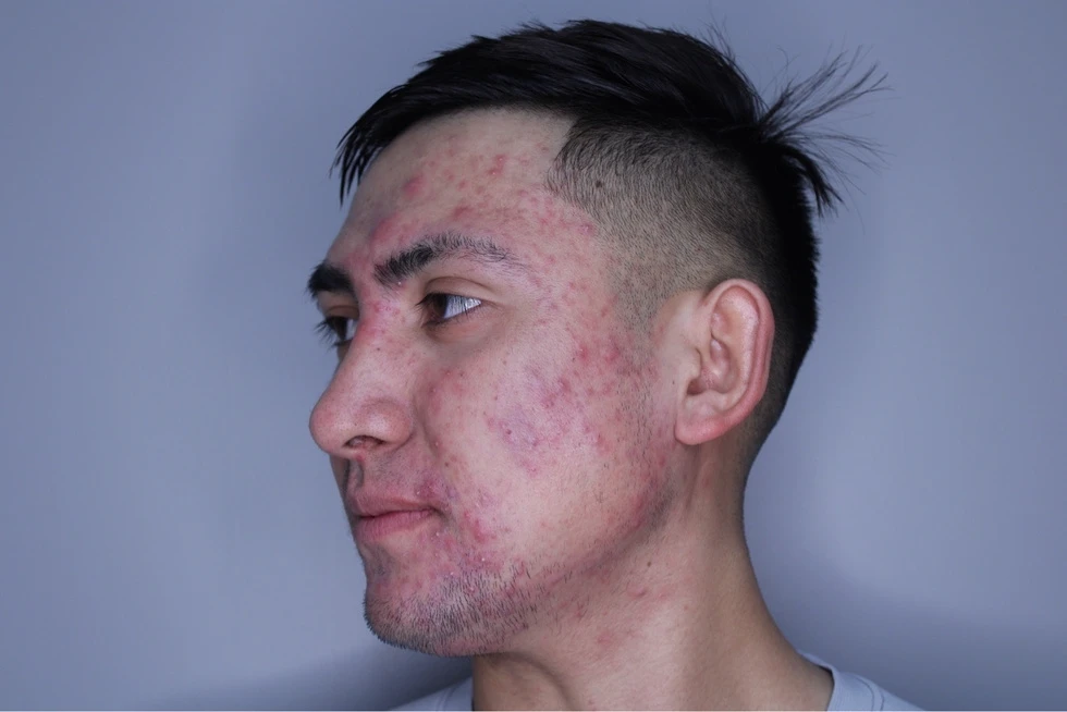 Skin Rejuvenation treatment Cloud9medspa