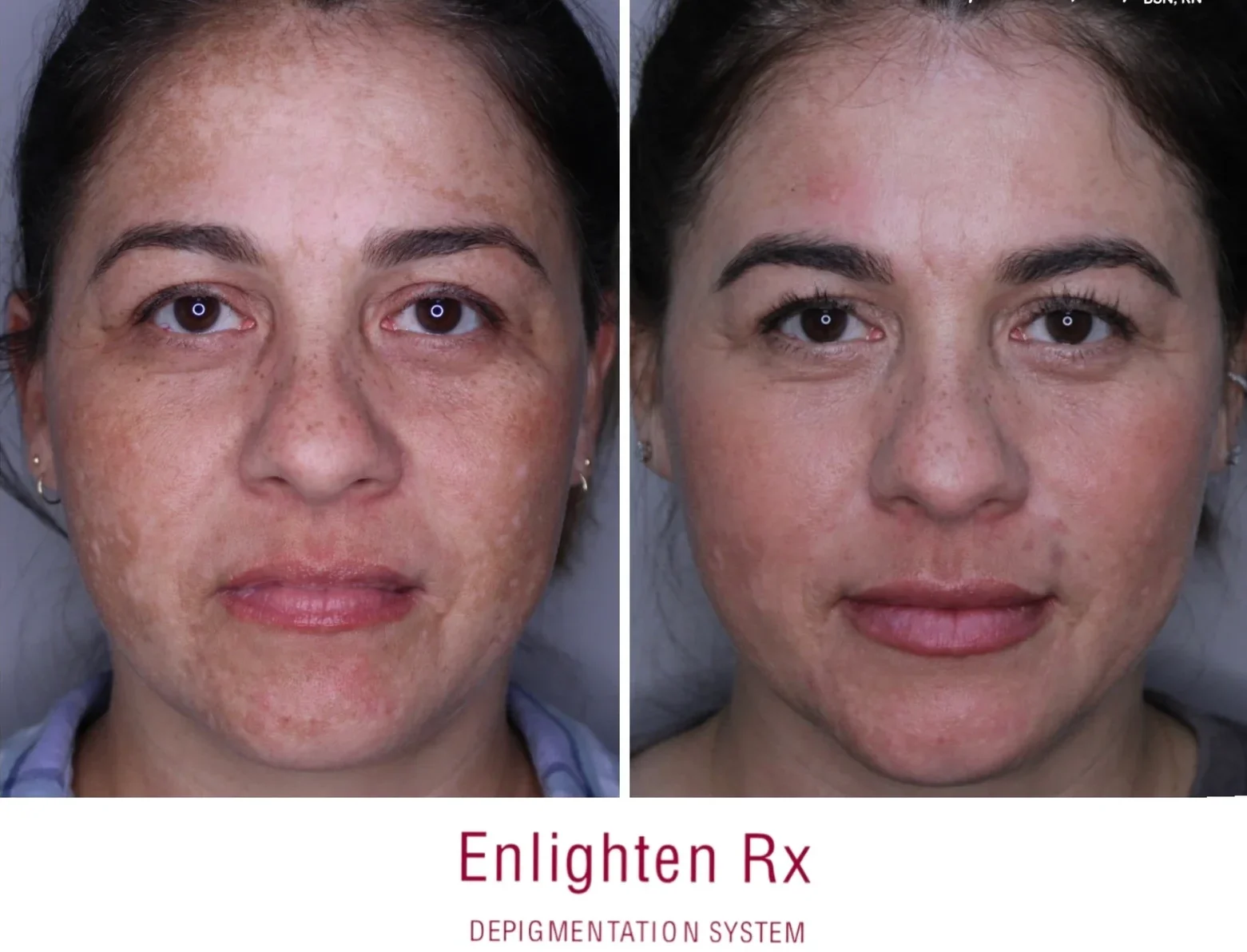 a comparison of a woman's face for SKIN REJUVENATION