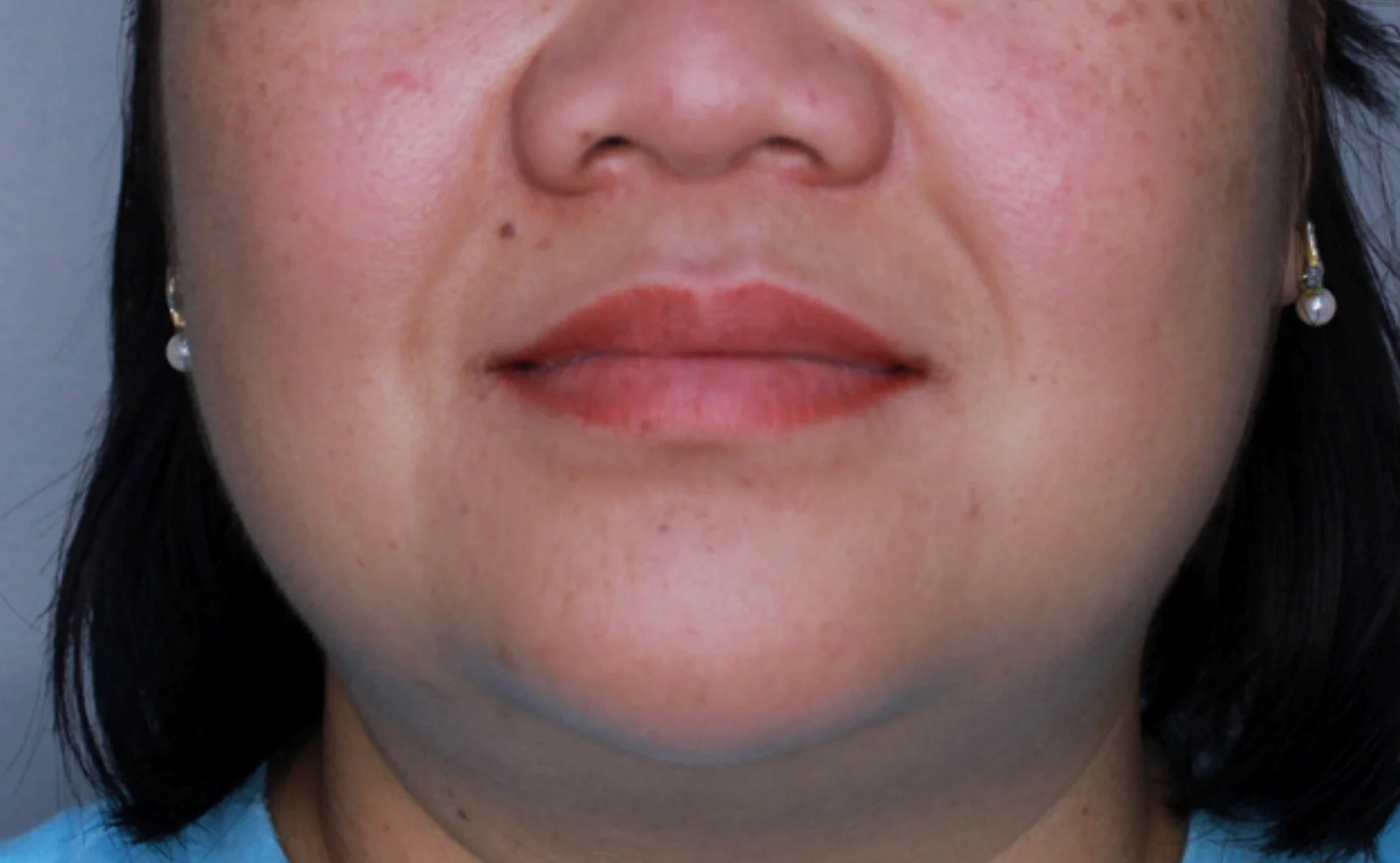 NEUROTOXINS & DERMAL FILLER