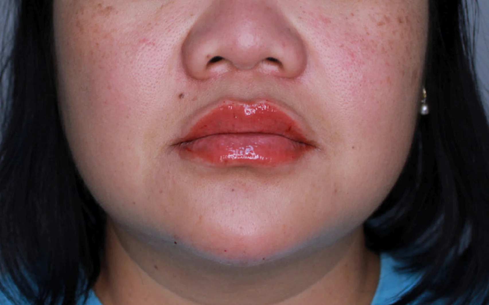 NEUROTOXINS & DERMAL FILLER TREATMENT