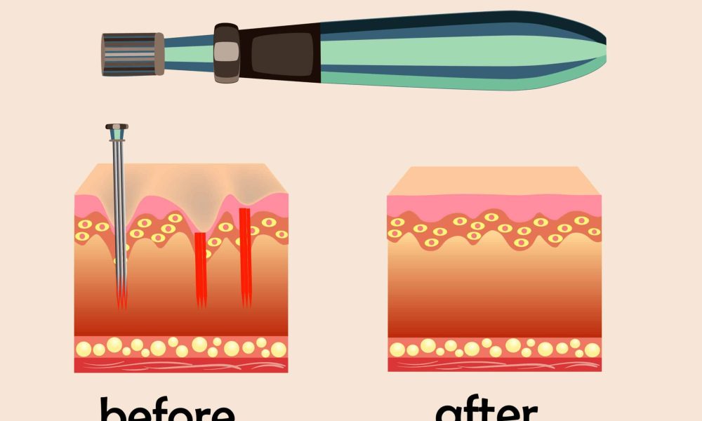 Before after effect, Microneedle stamping device, Collagen induction therapy | Cloud 9 MedSpa in Casa Grande, AZ